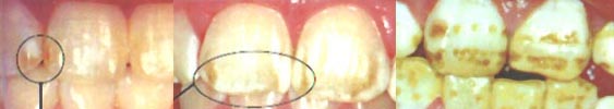 Projevy fluorózy na zubech